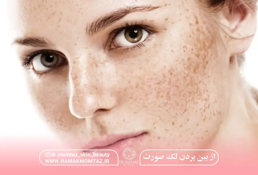 از بین بردن لک صورت