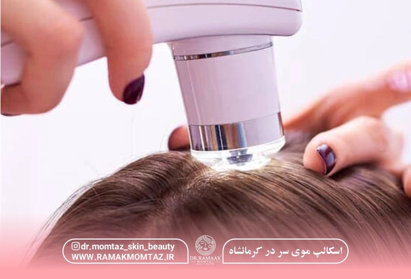 اسکالپ موی سر در کرمانشاه: هزینه 1404