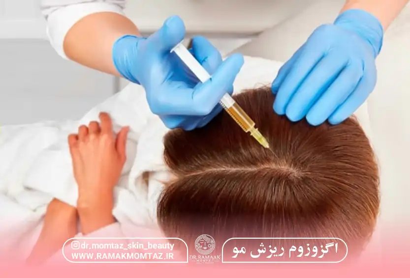 اگزوزوم ریزش مو