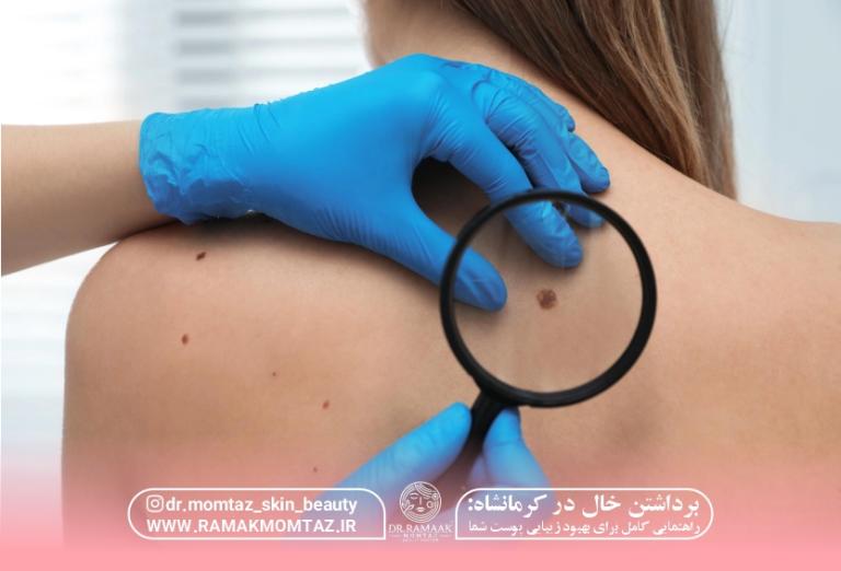 برداشتن خال در کرمانشاه راهنمایی کامل برای بهبود زیبایی پوست شما 1