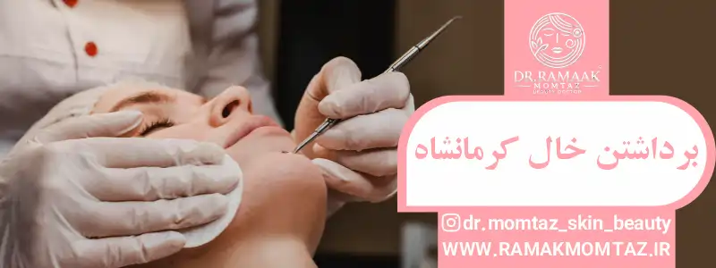 انواع خالها و روشهای مناسب برای برداشتن آنها