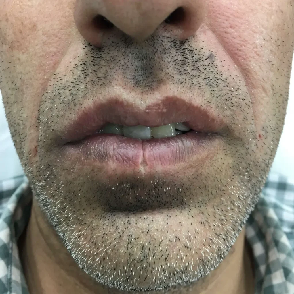 بعد از رفع خط خنده