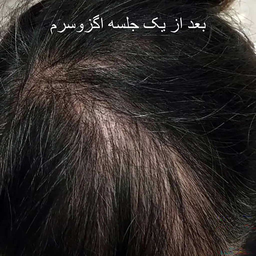 بعد از اگزوسرم کرمانشاه