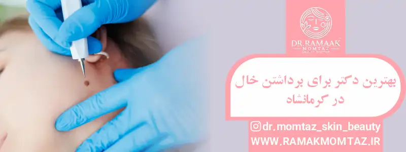 بهترین دکتر برای برداشتن خال در کرمانشاه