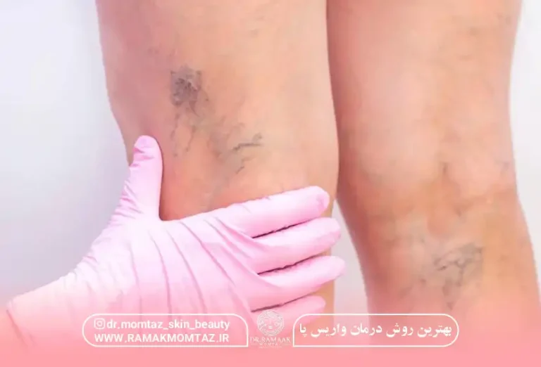 بهترین روش درمان واریس پا: روشی بدون نیاز به جراحی، با نتایج فوری و ماندگار