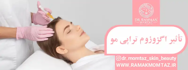 تأثیر اگزوزوم تراپی مو