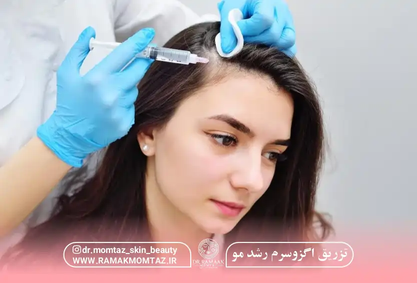 تزریق اگزوسرم رشد مو