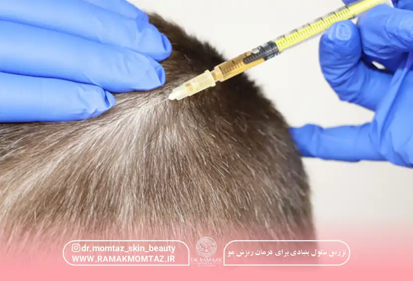 تزریق سلول بنیادی برای درمان ریزش مو