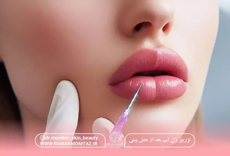 تزریق ژل لب بعد از عمل بینی