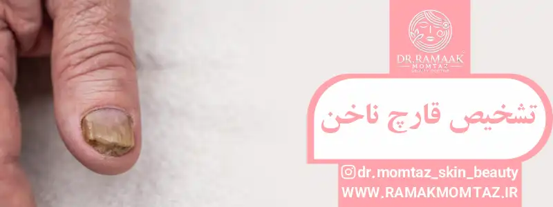 تشخیص قارچ ناخن