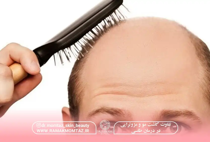 تفاوت کاشت مو و مزوتراپی