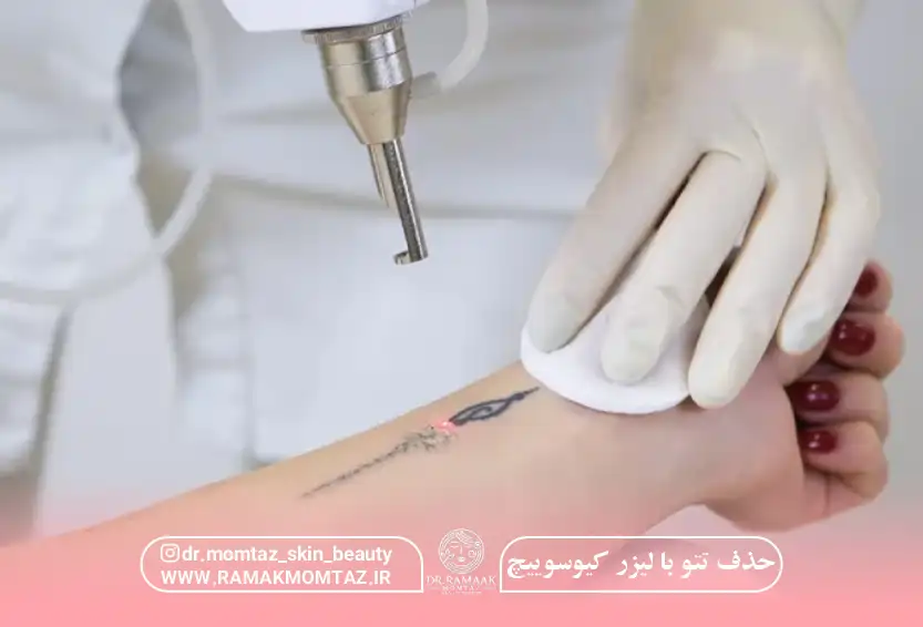 حذف تتو با لیزر کیوسوییچ