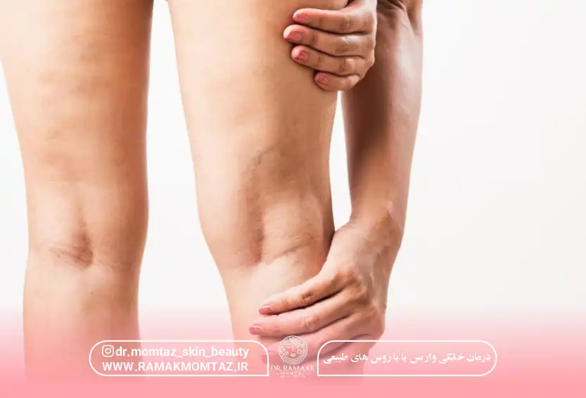 درمان خانگی واریس پا با روش های طبیعی