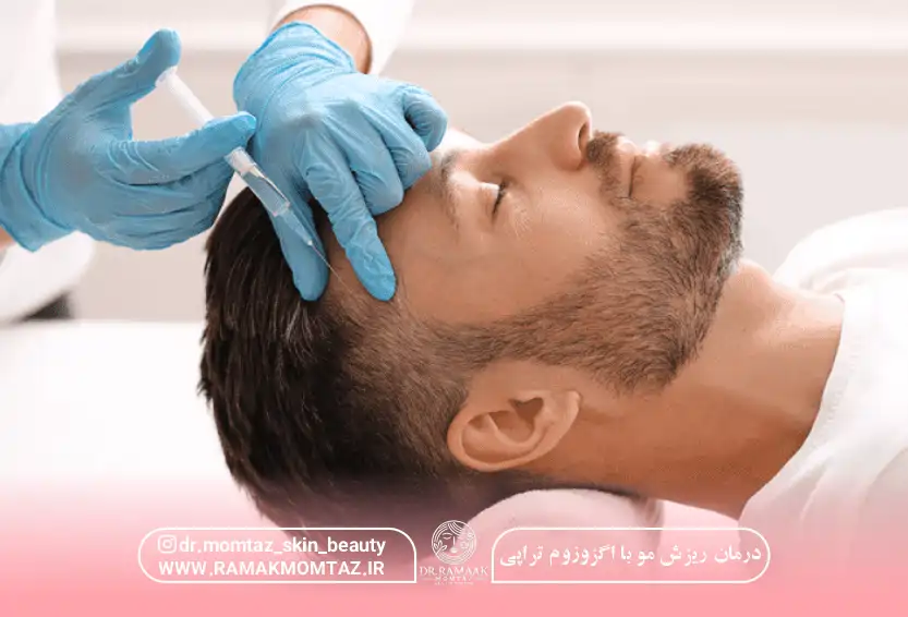 درمان ریزش مو با اگزوزوم تراپی + هزینه