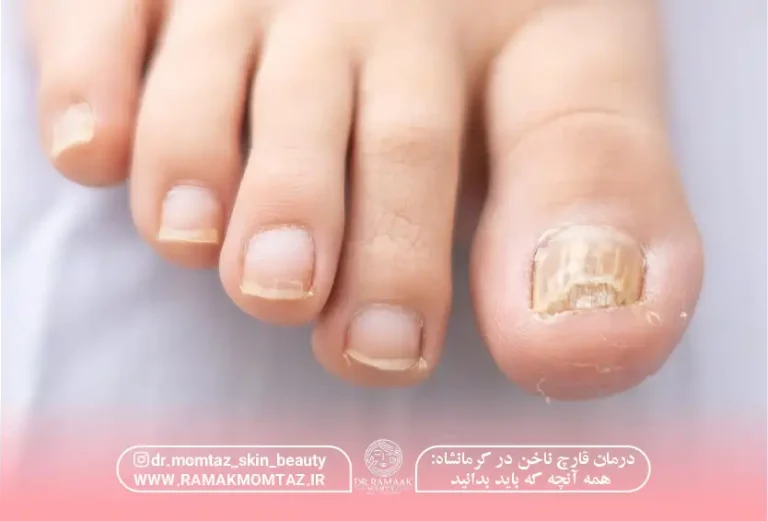 درمان قارچ ناخن در کرمانشاه: همه آنچه که باید بدانید