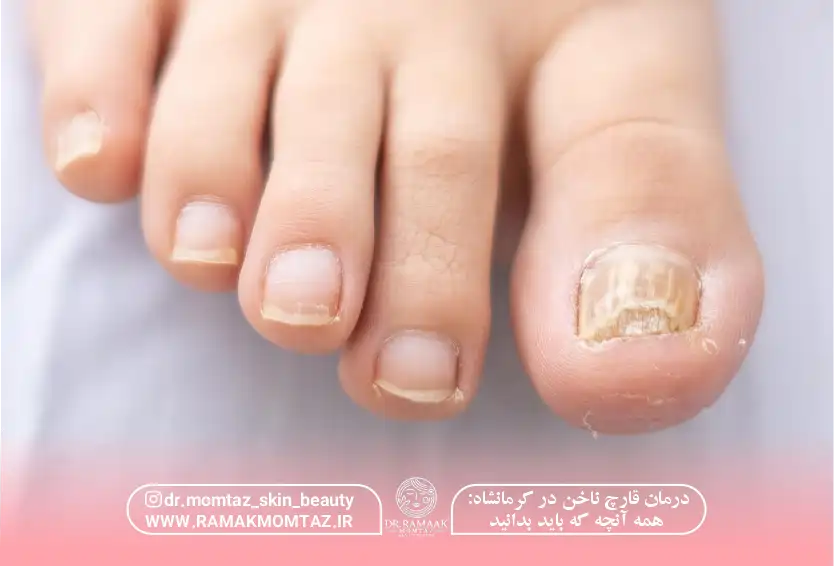 درمان قارچ ناخن در کرمانشاه: همه آنچه که باید بدانید