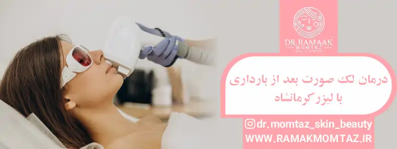 درمان لک صورت بعد از بارداری با لیزر در کرمانشاه