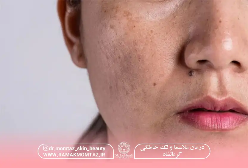 درمان ملاسما و رفع لک حاملگی کرمانشاه: بهترین روش + هزینه (1403)