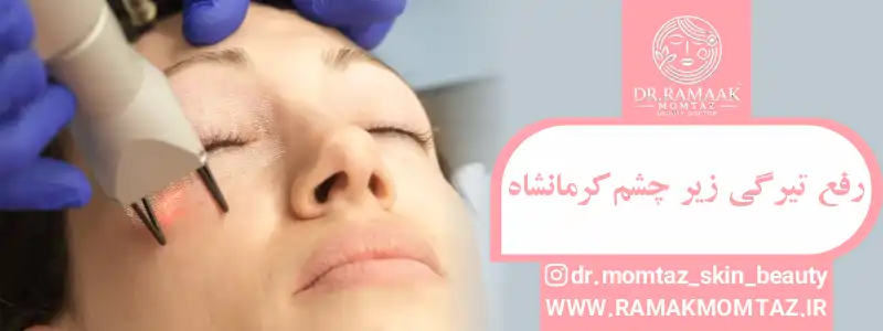 رفع ترگی زیر چشم کرمانشاه