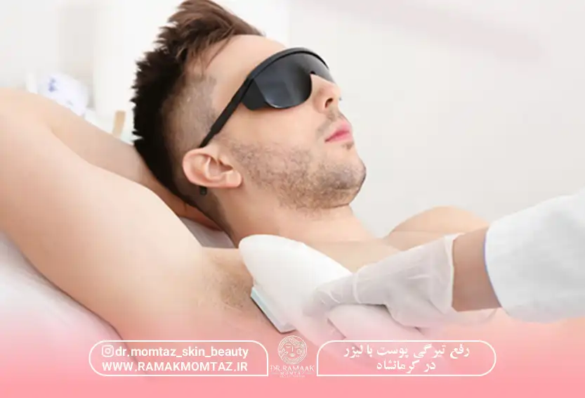 رفع تیرگی پوست با لیزر در کرمانشاه