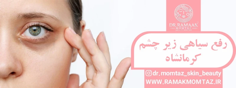 رفع سیاهی زیر چشم کرمانشاه