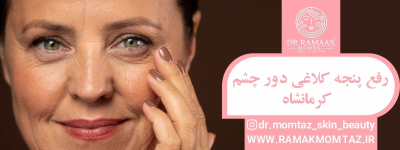 رفع پنجه کلاغی دور چشم کرمانشاه