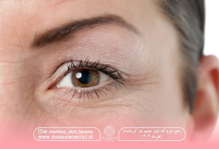 رفع چروک دور چشم در کرمانشاه (هزینه 1404)