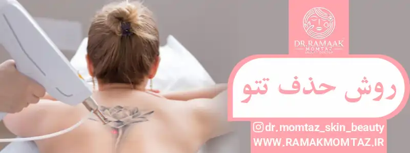 روش حذف تتو