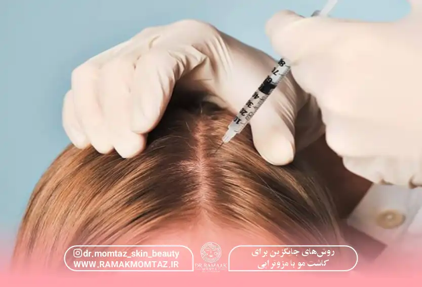 روش های جایگزین برای کاشت مو با مزوتراپی