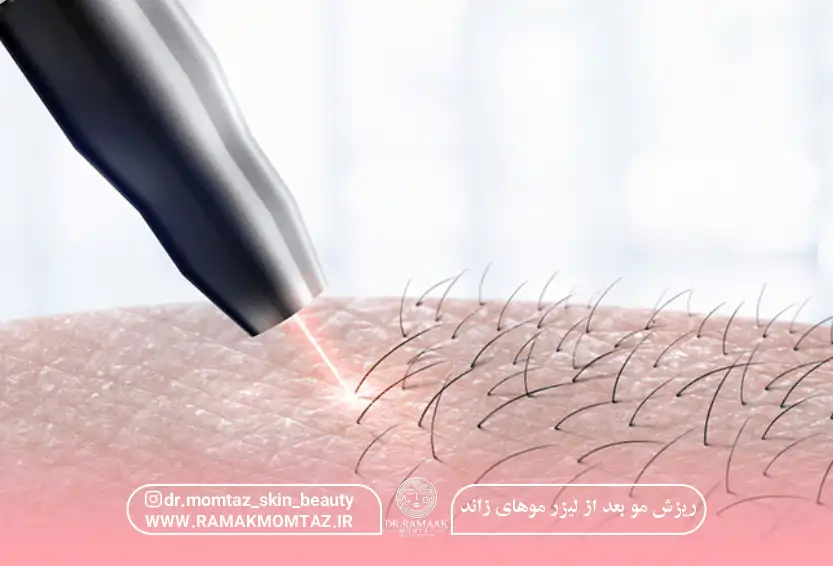 ریزش مو بعد از لیزر