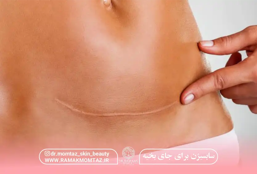 سابسیژن برای جای بخیه