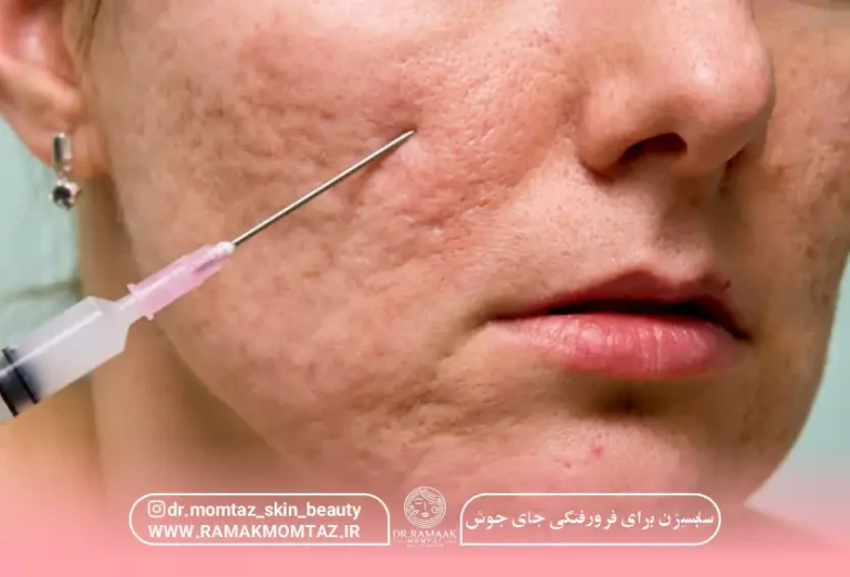 سابسیژن برای فرورفتگی جای جوش: درمانی مؤثر برای بهبود بافت پوست