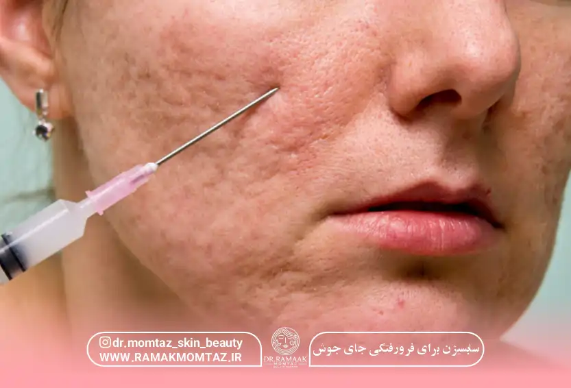 سابسیژن برای فرورفتگی جای جوش: درمانی مؤثر برای بهبود بافت پوست