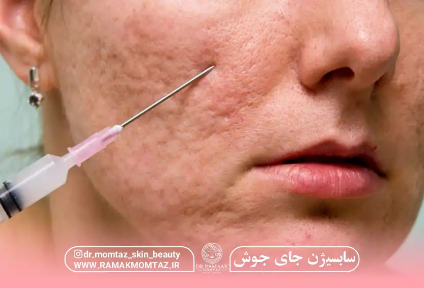 سابسیژن جای جوش کرمانشاه