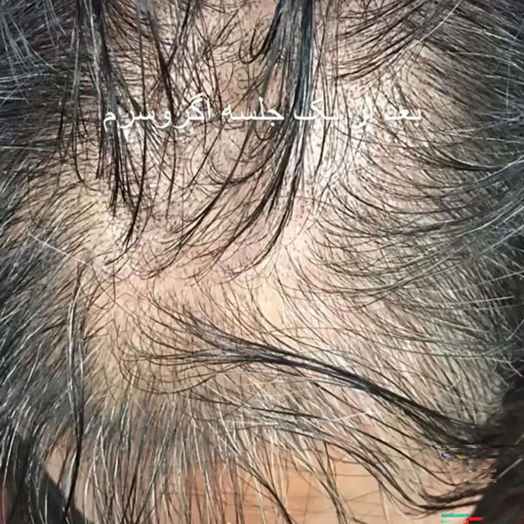 قبل اگزوسرم کرمانشاه