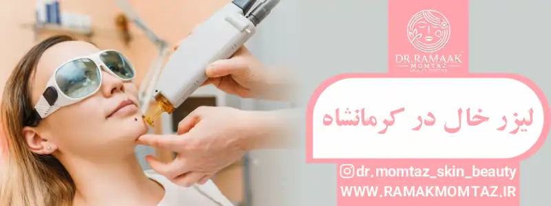 لیزر خال در کرمانشاه