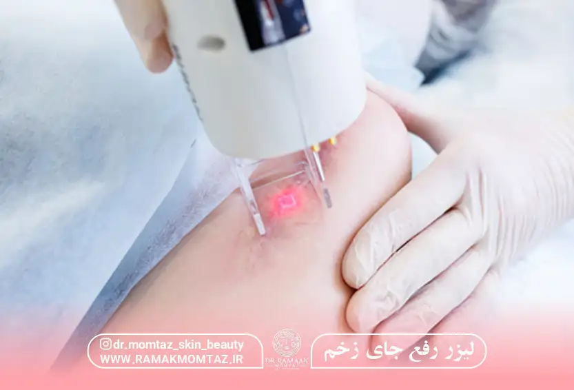 لیزر جای زخم کرمانشاه