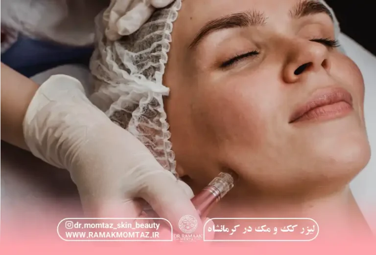 لیزر کک و مک در کرمانشاه