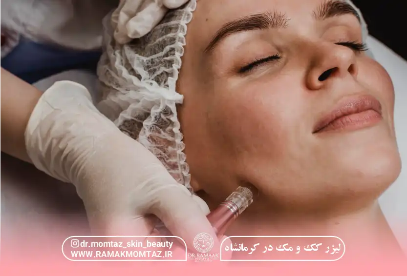 لیزر کک و مک در کرمانشاه