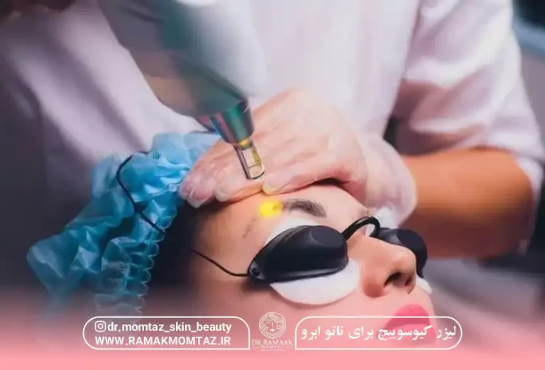لیزر کیوسوییچ پاک کردن تتو؛ بهترین روش حذف تتو بدون درد