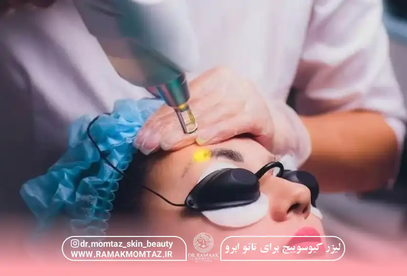 لیزر کیوسوییچ پاک کردن تتو؛ بهترین روش حذف تتو بدون درد