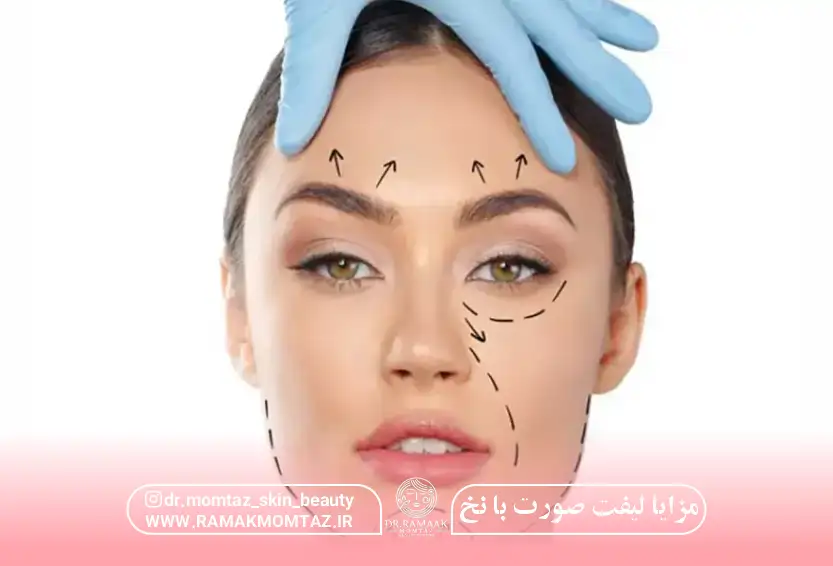 مزایا لیفت صورت با نخ