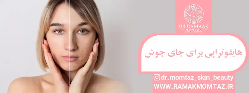 هایفوتراپی برای جای جوش