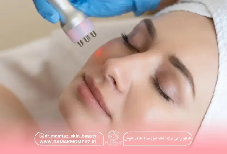 هایفوتراپی برای لک صورت و جای جوش: تعداد جلسات و سن مناسب {1404}