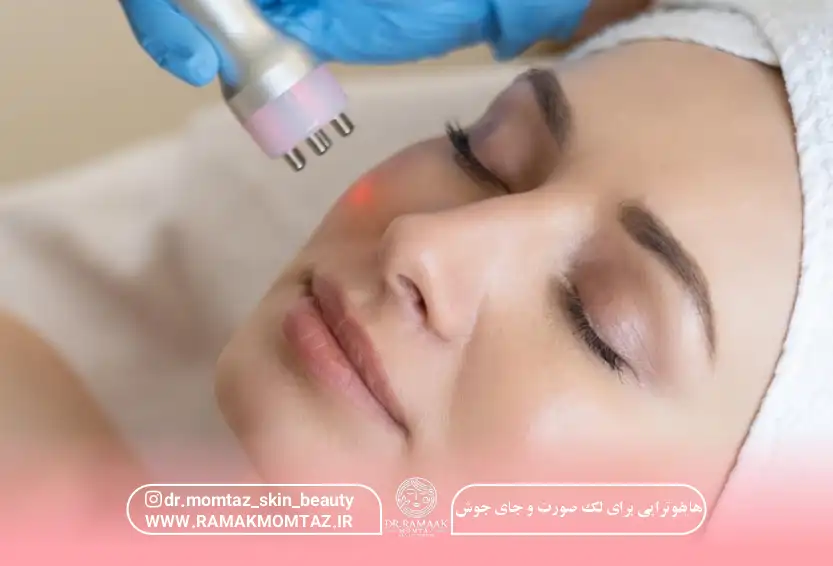 هایفوتراپی برای لک صورت و جای جوش: تعداد جلسات و سن مناسب {1404}