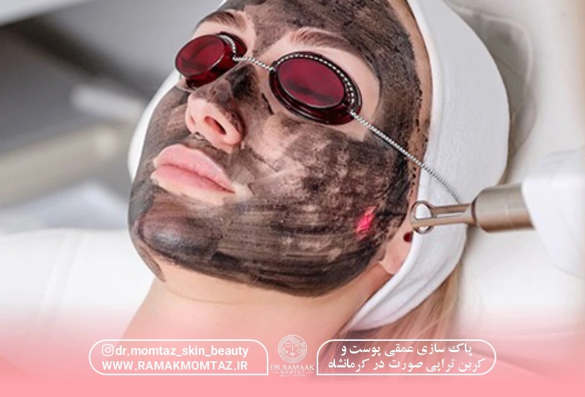 پاک سازی عمقی پوست و کربن تراپی صورت در کرمانشاه