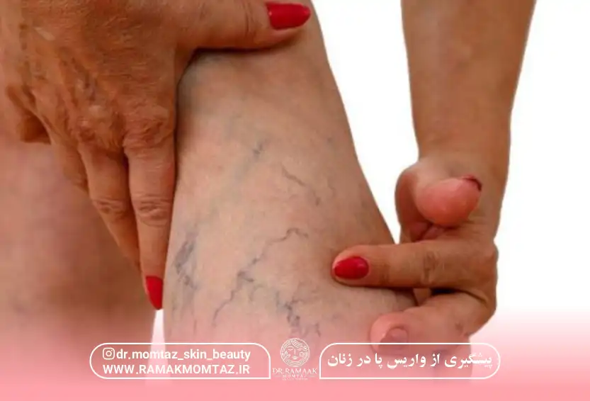 پیشگیری از واریس پا در زنان