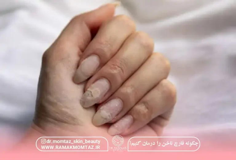 چگونه قارچ ناخن را درمان کنیم